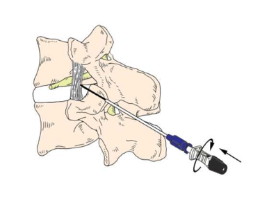 RF NEEDLE